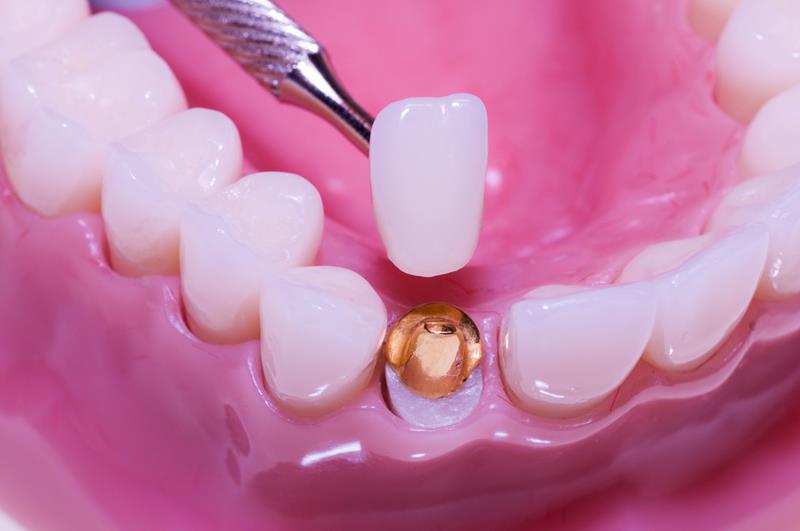 Cracked & Broken Teeth