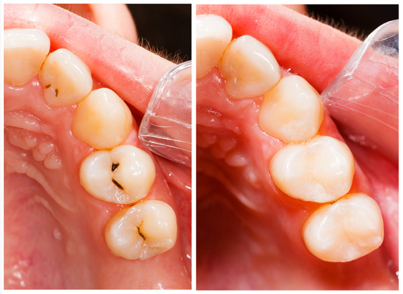 Tooth Decay & Cavities