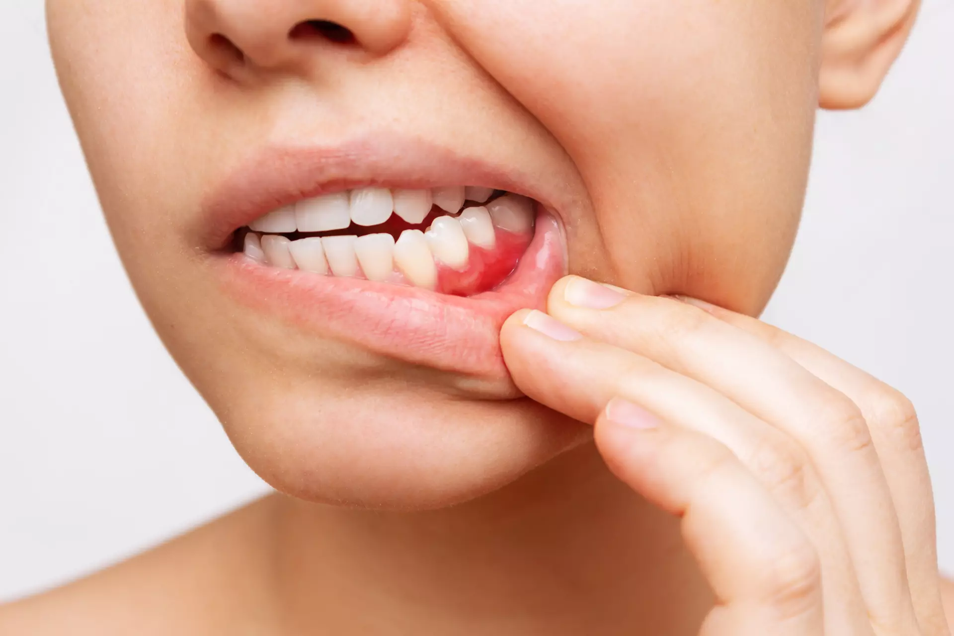 Bad Breath (Halitosis)